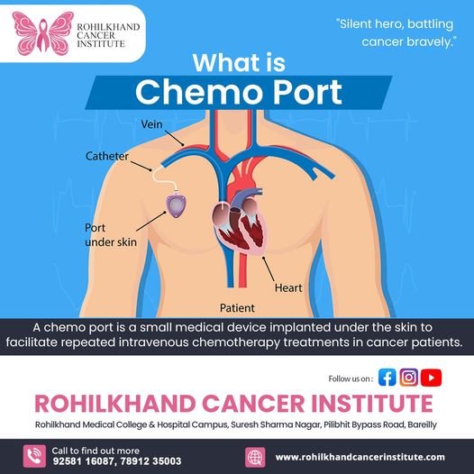 what-is-chemo-port Rohilkhand Cancer Institute, Rohilkhand Medical Collage And Hospitals Campus, Pilibhit Bypass Road -243006, Uttar Pradesh, India