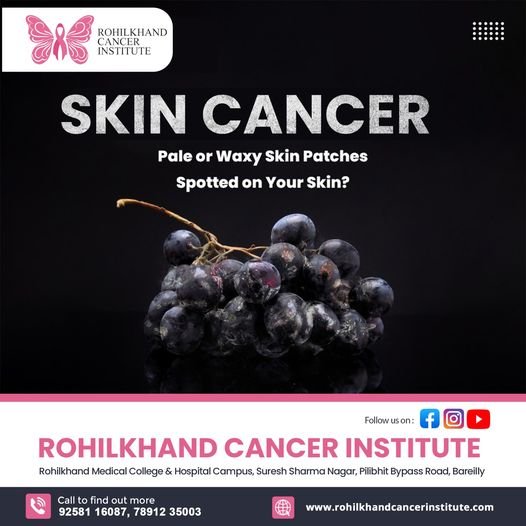 Best Skin Cancer Institute in Bareilly | Rohilkhand Cancer Institute