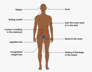 Cancer - Symptoms and causes - Rohilkhand Cancer Institute | Pet CT Scan in Bareilly