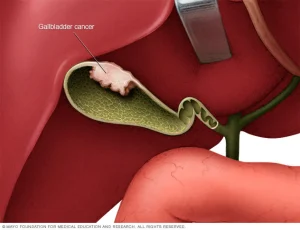 Gallbladder-cancer-Rohilkhand-Cancer-Institute-Pet-CT-Scan-in-Bareilly