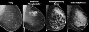 What Is a Mammogram - Rohilkhand Cancer Institute | Pet CT Scan in Bareilly 