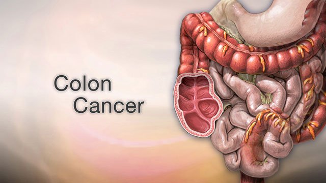 Colon Cancer Signs And Symptoms - Rohilkhand Cancer Institute | Pet CT ...