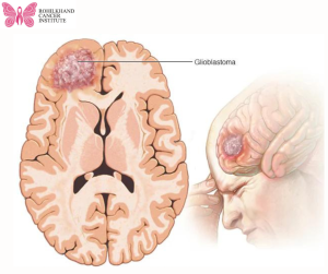 Brain tumor - Rohilkhand Cancer Institute | Pet CT Scan in Bareilly