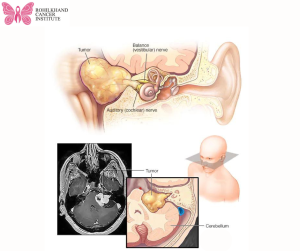 Brain tumor - Rohilkhand Cancer Institute | Pet CT Scan in Bareilly