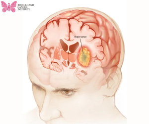 Brain tumor - Rohilkhand Cancer Institute | Pet CT Scan in Bareilly