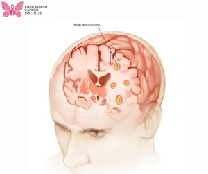 Brain tumor - Rohilkhand Cancer Institute | Pet CT Scan in Bareilly