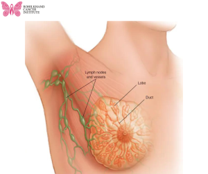 ब्रेस्ट कैंसर लक्षण और कारण और जोखिम - Rohilkhand Cancer Institute | Pet CT Scan in Bareilly