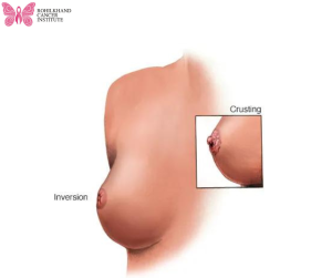 ब्रेस्ट कैंसर लक्षण और कारण और जोखिम - Rohilkhand Cancer Institute | Pet CT Scan in Bareilly