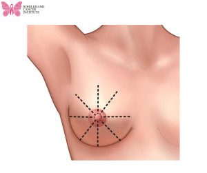 ब्रेस्ट कैंसर लक्षण और कारण और जोखिम - Rohilkhand Cancer Institute | Pet CT Scan in Bareilly
