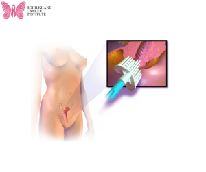 सर्वाइकल कैंसर - Rohilkhand Cancer Institute Pet CT Scan in Bareilly - (2)