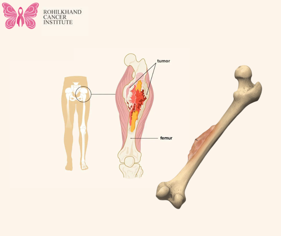 Bone cancer - Rohilkhand Cancer Institute | Pet CT Scan in Bareilly