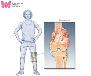 Bone cancer - Rohilkhand Cancer Institute | Pet CT Scan in Bareilly