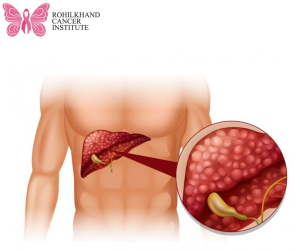 Liver Cancer - Rohilkhand Cancer Institute | Pet CT Scan in Bareilly
