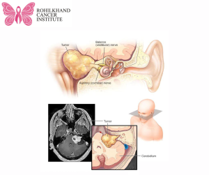Brain tumor - Symptoms and causes - Rohilkhand Cancer Institute | Pet CT Scan in Bareilly
