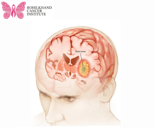 Brain tumor - Symptoms and causes - Rohilkhand Cancer Institute | Pet CT Scan in Bareilly
