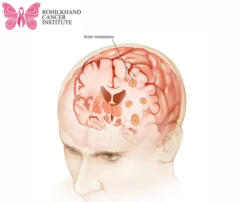 Brain tumor – Symptoms and causes - Rohilkhand Cancer Institute | Pet ...