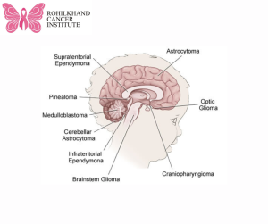 Childhood Cancer Pediatric Brain Tumors - Rohilkhand Cancer Institute Pet CT Scan in Bareilly (2)