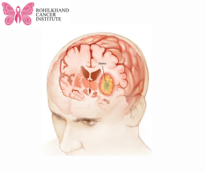 Childhood Cancer Pediatric Brain Tumors - Rohilkhand Cancer Institute Pet CT Scan in Bareilly (3)