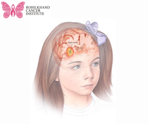 Childhood Cancer Pediatric Brain Tumors - Rohilkhand Cancer Institute Pet CT Scan in Bareilly (1)