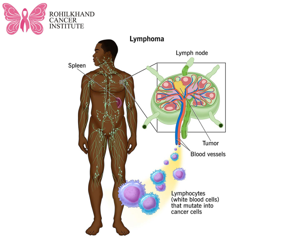 Image showcasing Leukemia Symptoms and causes - Rohilkhand Cancer Institute | Pet CT ...