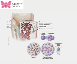 Leukemia Symptoms and causes - Rohilkhand Cancer Institute | Pet CT Scan in Bareilly