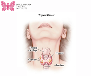 Thyroid cancer - Rohilkhand Cancer Institute Pet CT Scan in Bareilly (3)