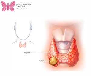 Thyroid cancer - Rohilkhand Cancer Institute | Pet CT Scan in Bareilly