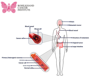 Cancer in Bareilly - Rohilkhand Cancer Institute Pet CT Scan in Bareilly