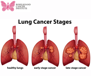 Lung cancer - Rohilkhand Cancer Institute | Pet CT Scan in Bareilly