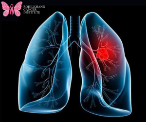 Lung cancer - Rohilkhand Cancer Institute | Pet CT Scan in Bareilly