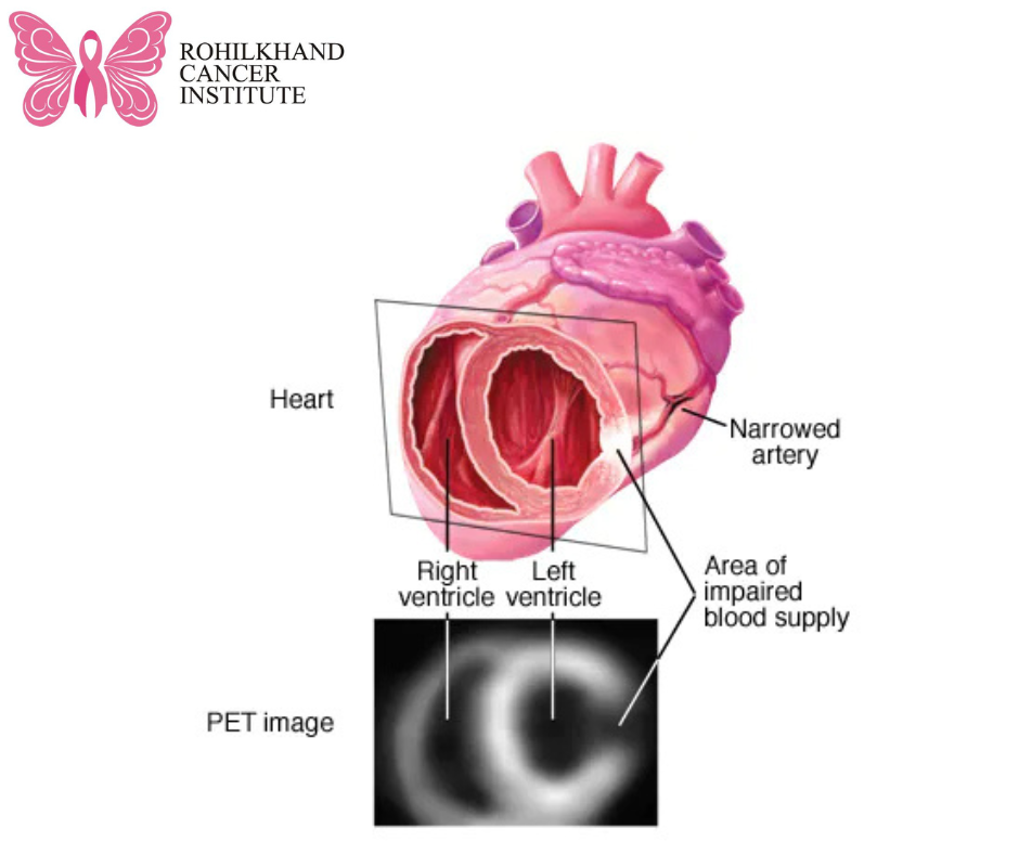 Best PET Scan in Bareilly-Rohilkhand Cancer Institute