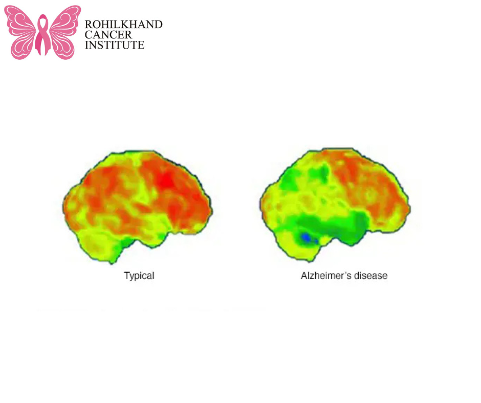 Best PET Scan in Bareilly-Rohilkhand Cancer Institute