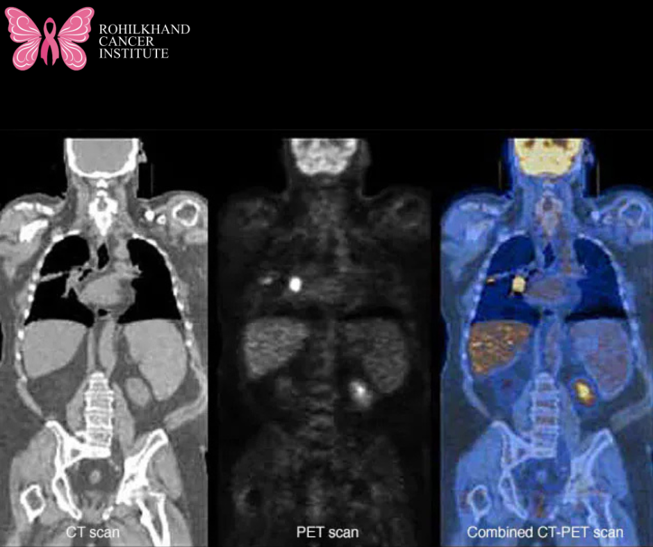 Best PET Scan in Bareilly-Rohilkhand Cancer Institute