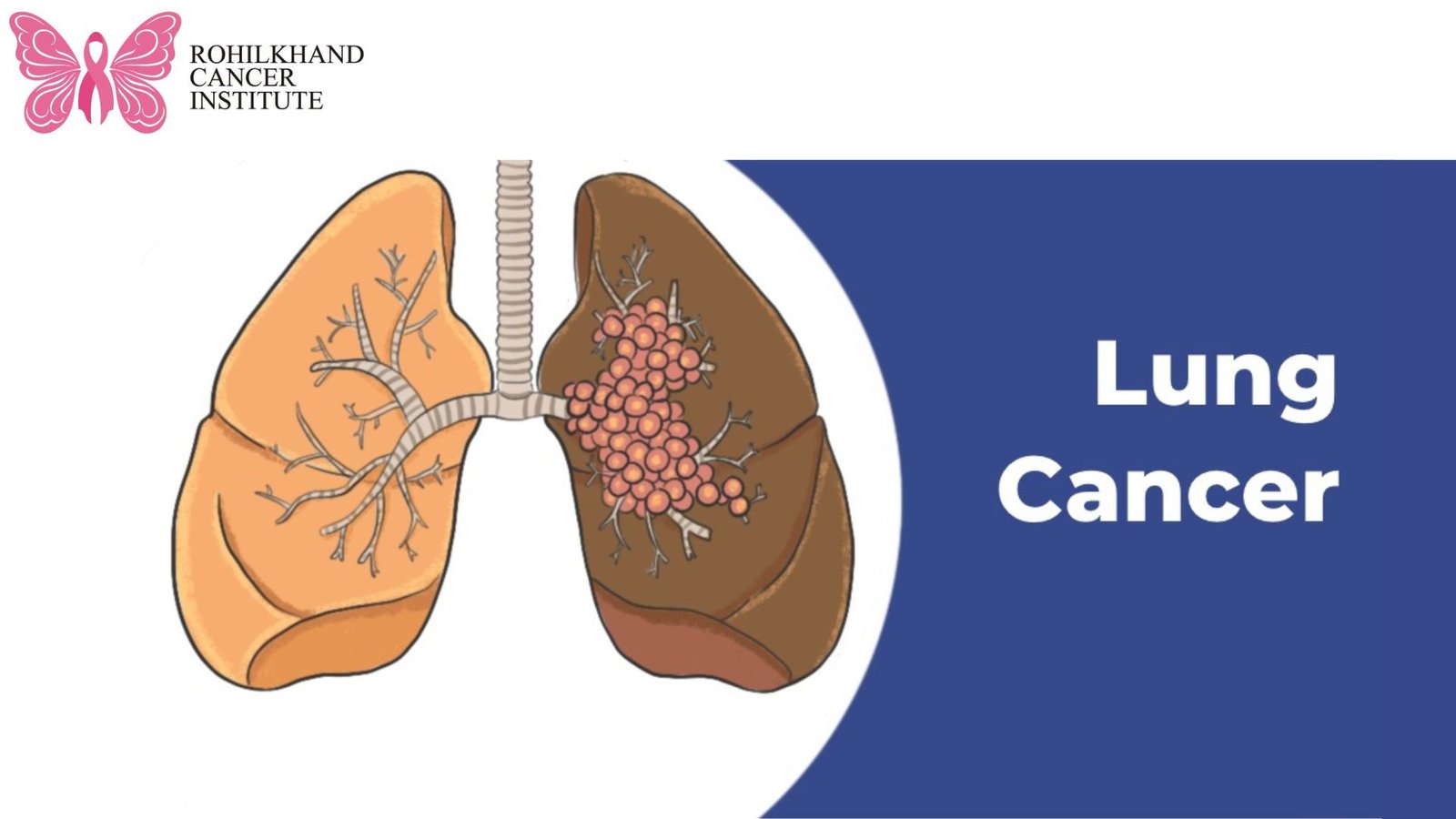 फेफड़े के कैंसर - Rohilkhand Cancer Institute | Pet CT Scan in Bareilly