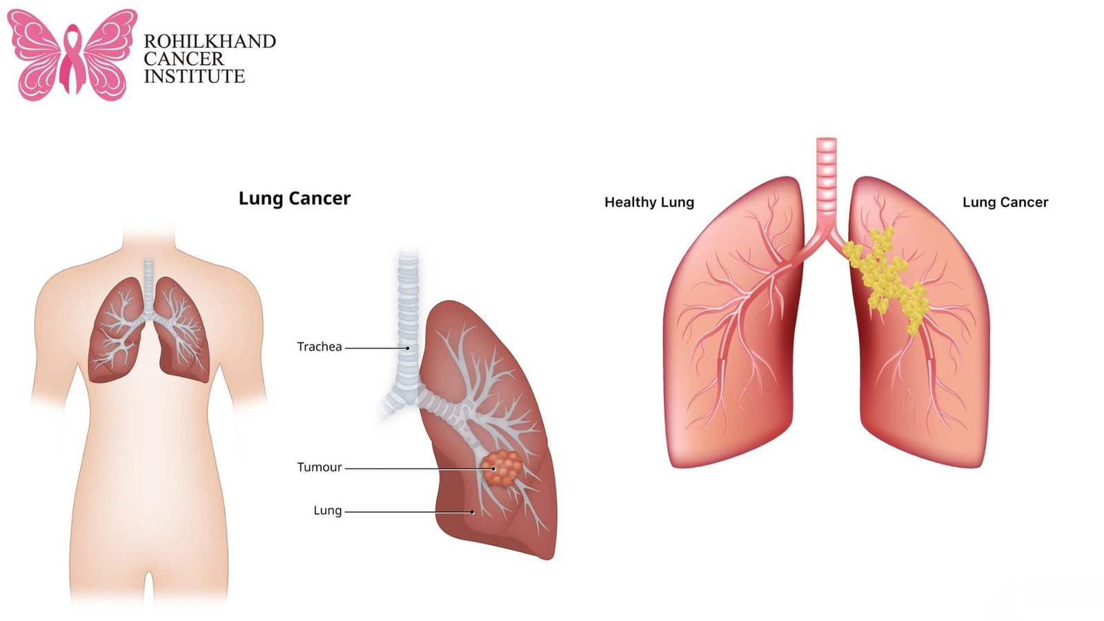 फेफड़े के कैंसर - Rohilkhand Cancer Institute | Pet CT Scan in Bareilly