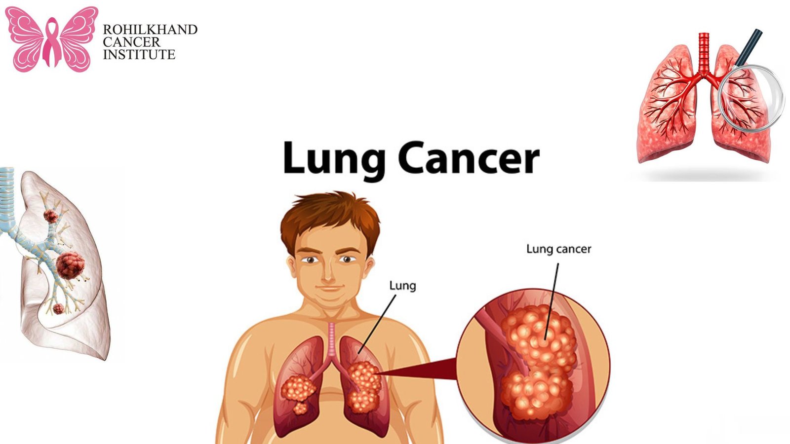 फेफड़े के कैंसर - Rohilkhand Cancer Institute | Pet CT Scan in Bareilly