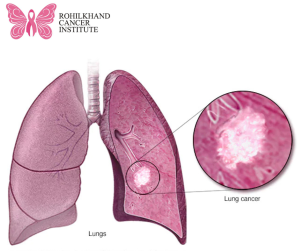 फेफड़े के कैंसर - Rohilkhand Cancer Institute | Pet CT Scan in Bareilly