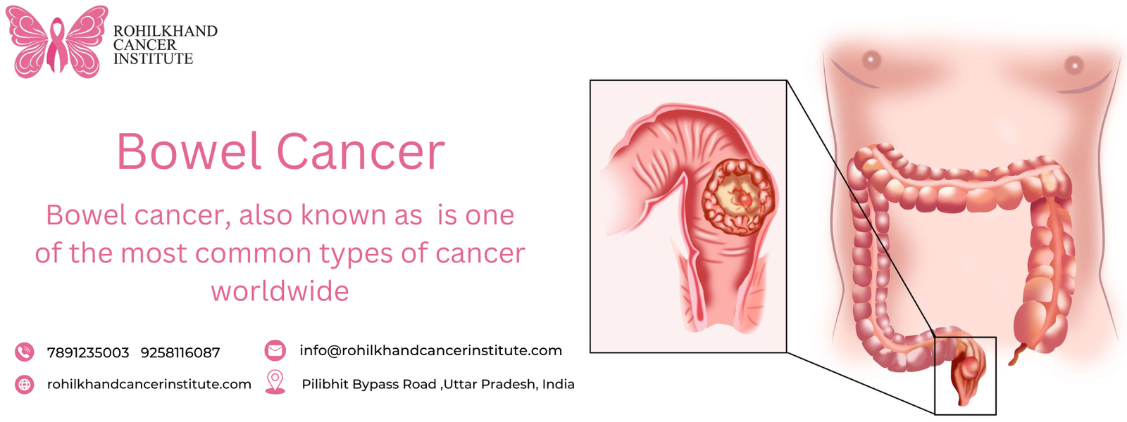 Bowel Cancer - Rohilkhand Cancer Institute | Pet CT Scan in Bareilly 