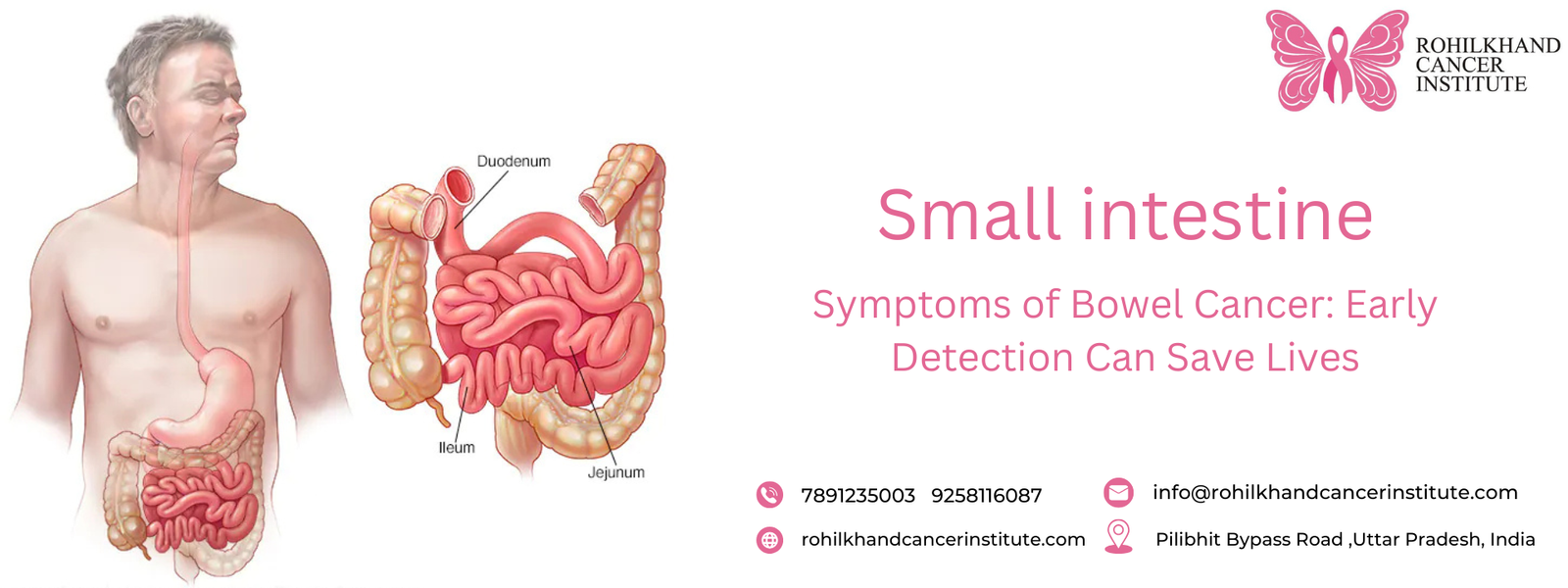 Bowel Cancer - Rohilkhand Cancer Institute | Pet CT Scan in Bareilly 