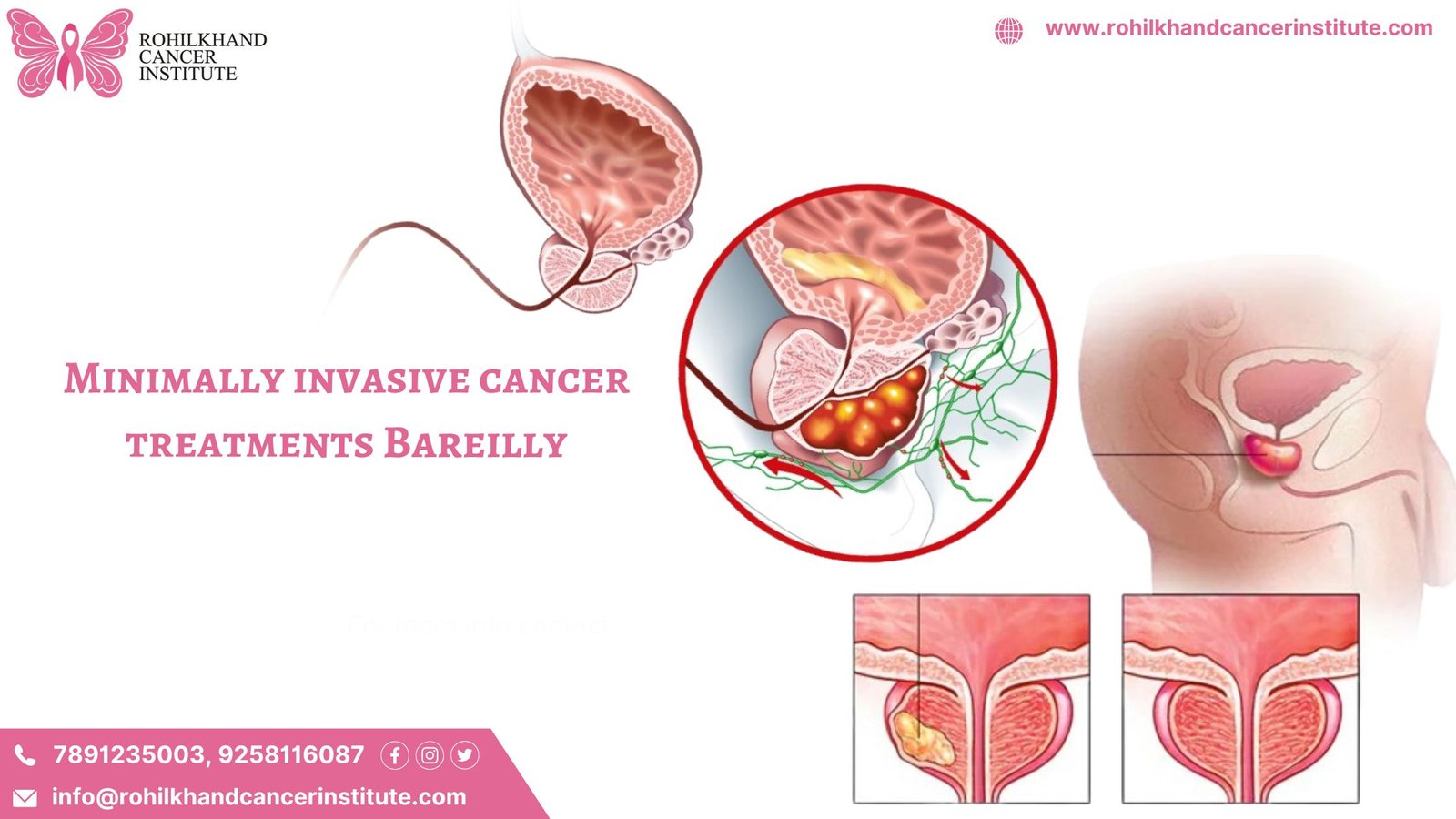 Minimally invasive cancer treatments Bareilly