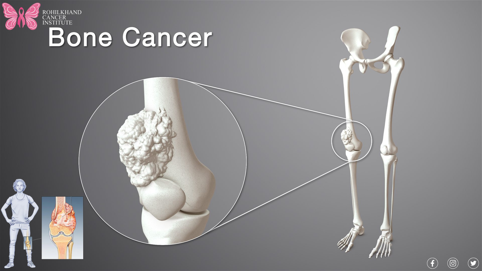 Bone cancer in bareilly