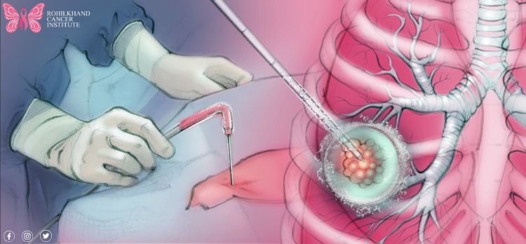 Cancer ablation procedures Bareilly