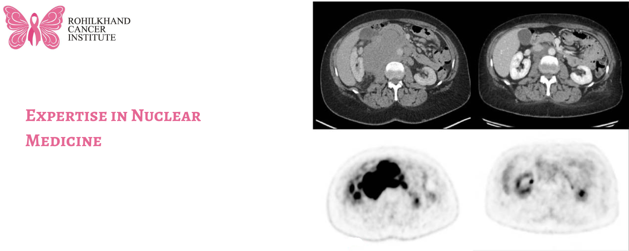 Nuclear medicine for cancer Bareilly 
