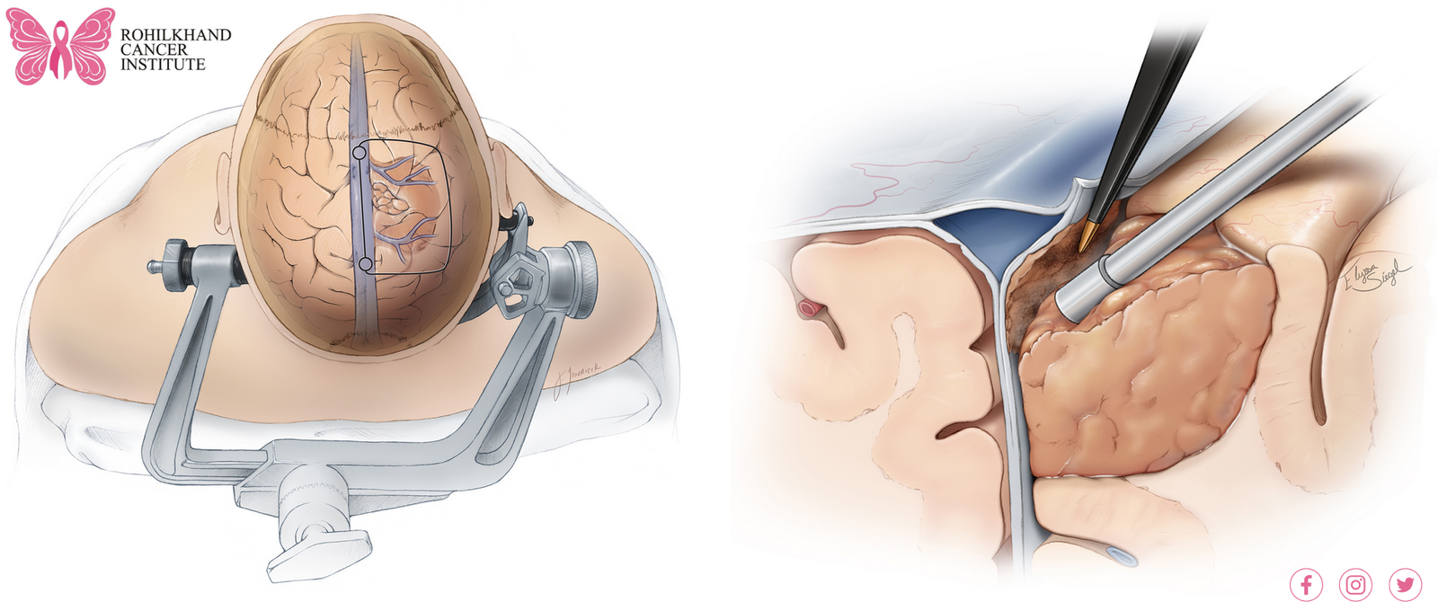 Tumor removal surgery Bareilly