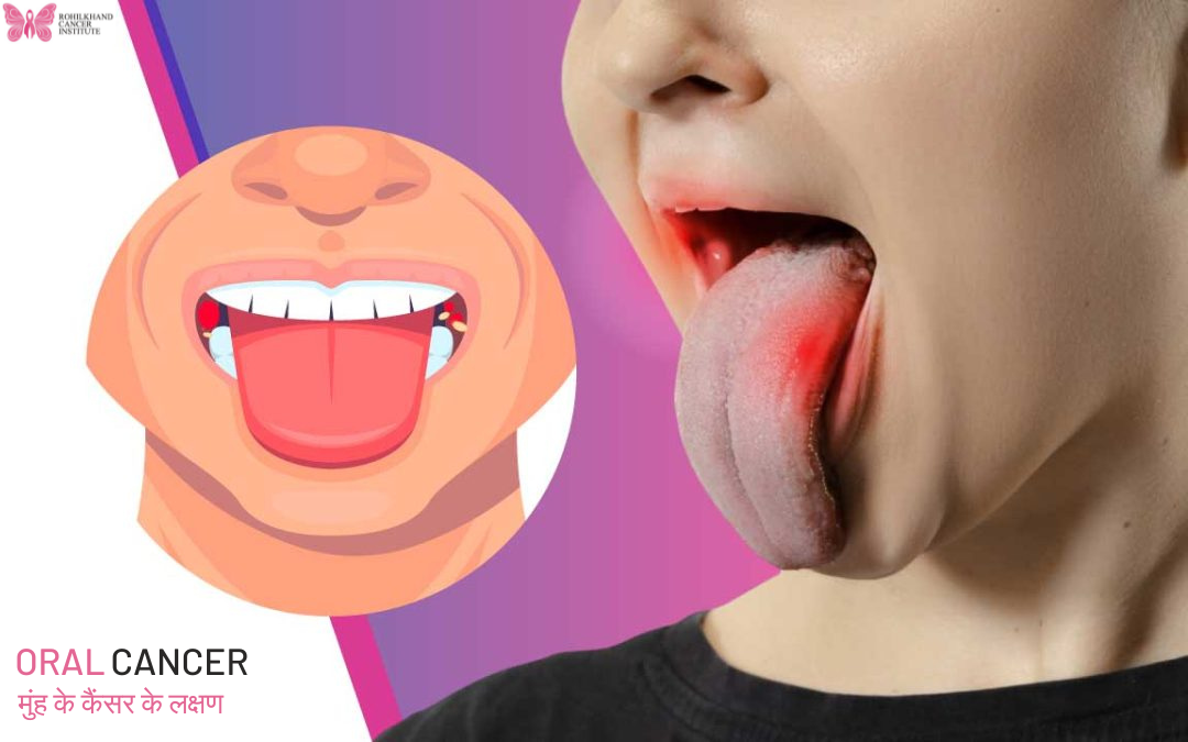Oral Cancer मुंह के कैंसर के लक्षण