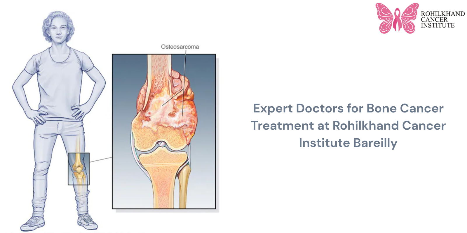 Expert Doctors for Bone Cancer Treatment at Rohilkhand Cancer Institute, Bareilly
