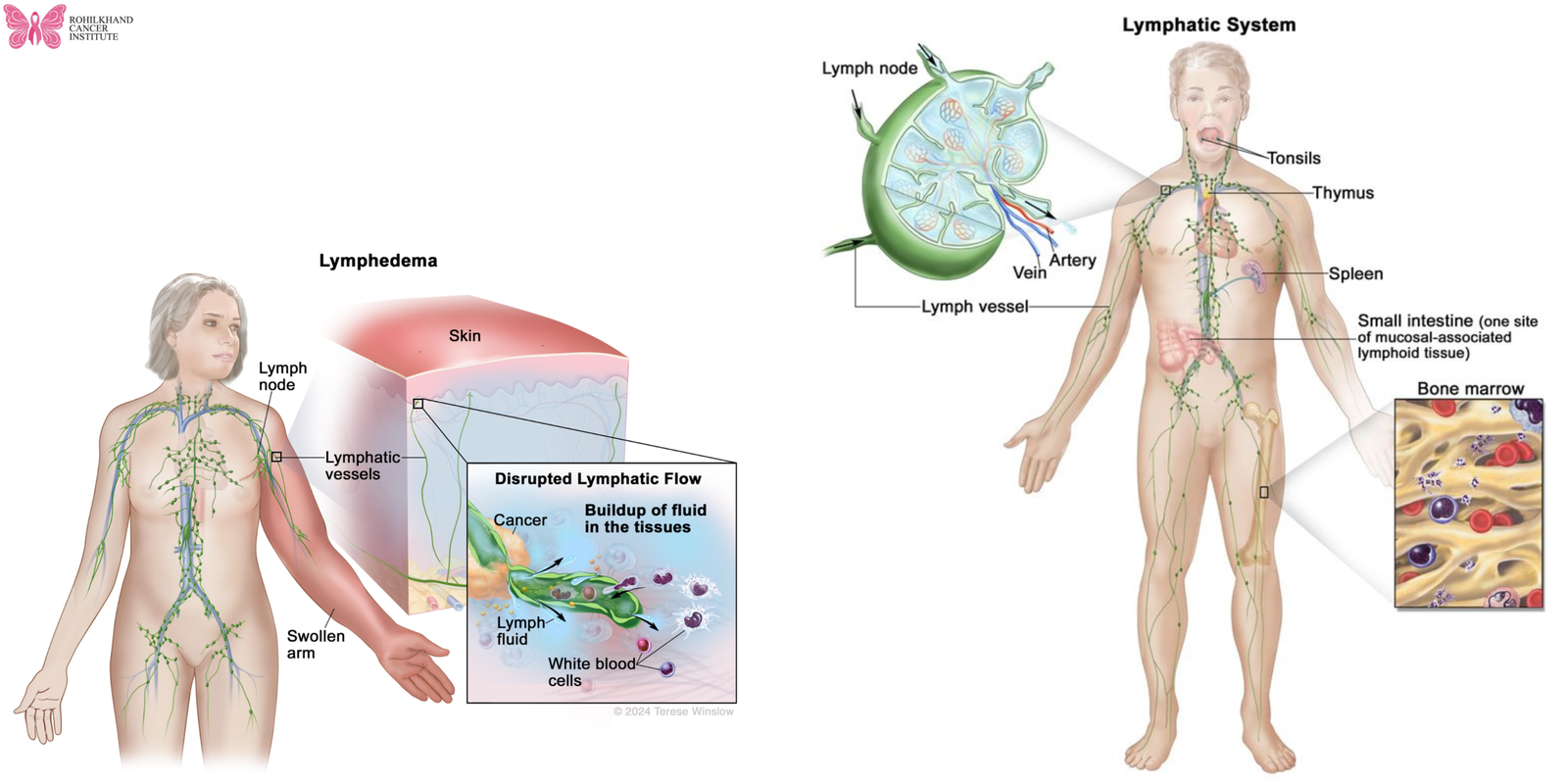 Advanced Leukemia & Lymphoma Treatment in Uttar Pradesh at Rohilkhand Cancer Institute