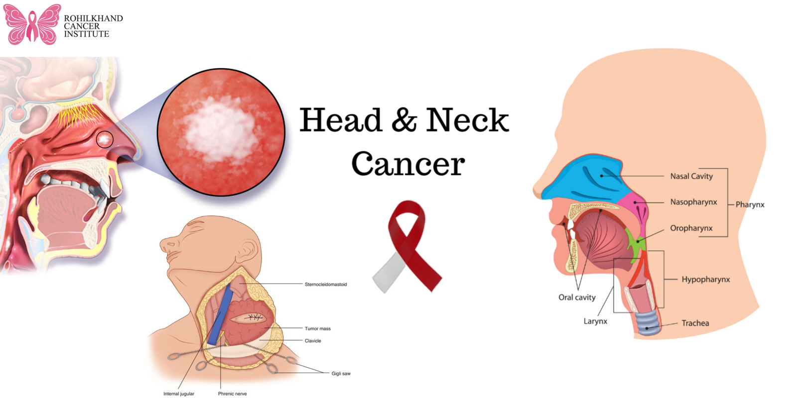 Comprehensive Head and Neck Cancer Treatment in Uttar Pradesh | Rohilkhand Cancer Institute