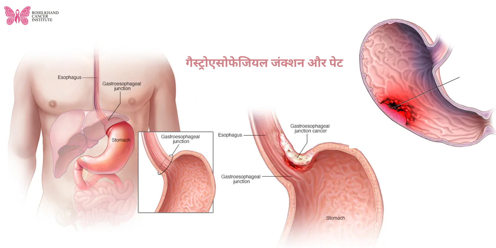 Stomach Cancer Care: Symptoms, Causes, and Treatment at Rohilkhand Cancer Institute