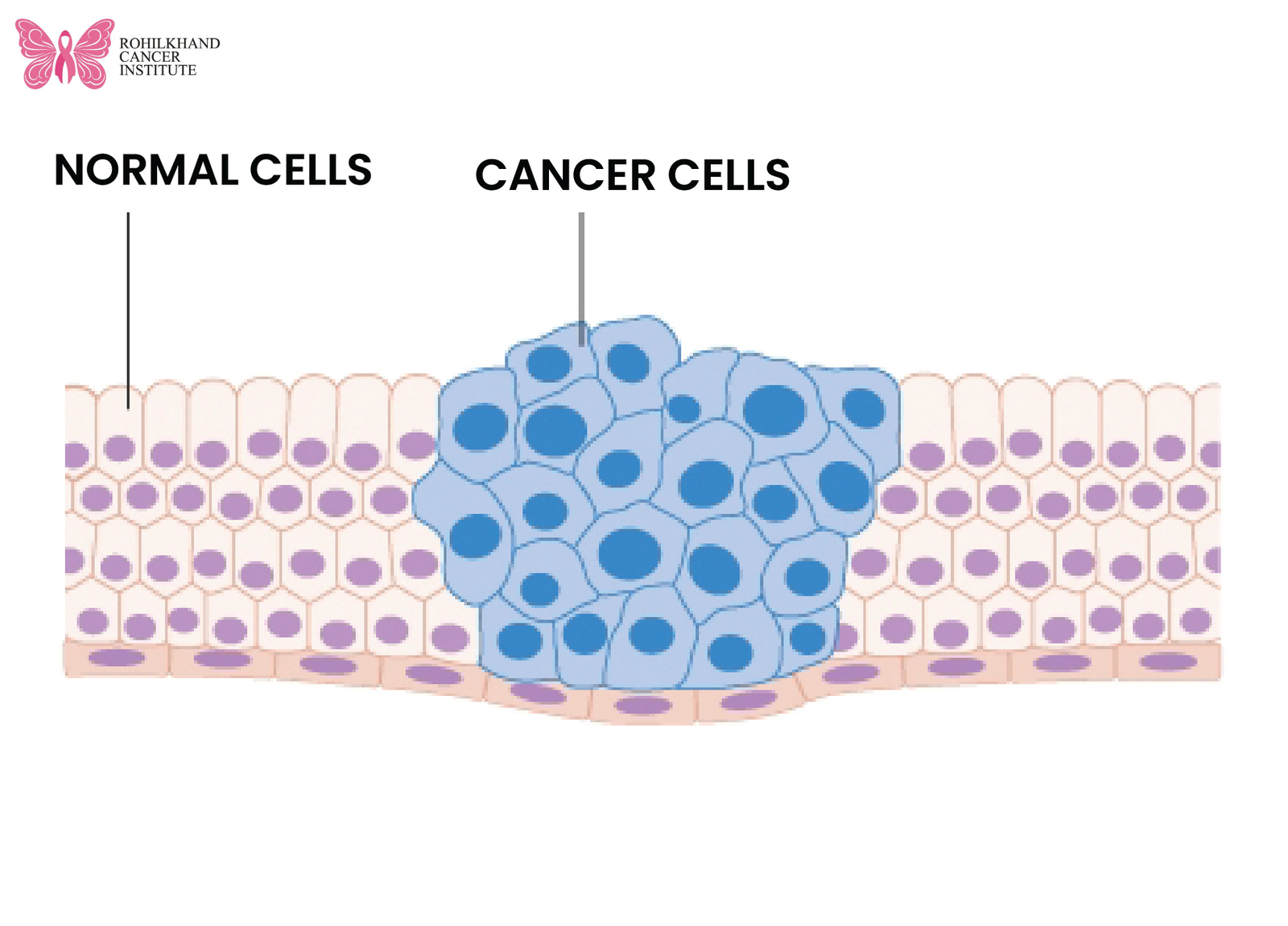 Cancer Specialist in Uttarakhand – Expert Treatment at Rohilkhand Cancer Institute